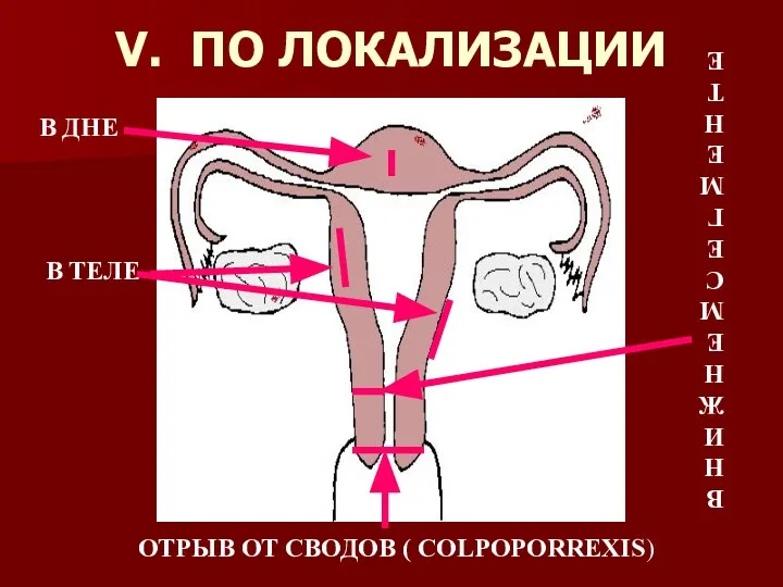 V. ПО ЛОКАЛИЗАЦИИ В ДНЕ В ТЕЛЕ В НИЖНЕМ СЕГМЕНТЕ ОТРЫВ ОТ СВОДОВ ( COLPOPORREXIS)