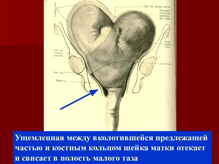 Ущемленная между вколотившейся предлежащей частью и костным кольцом шейка матки отекает