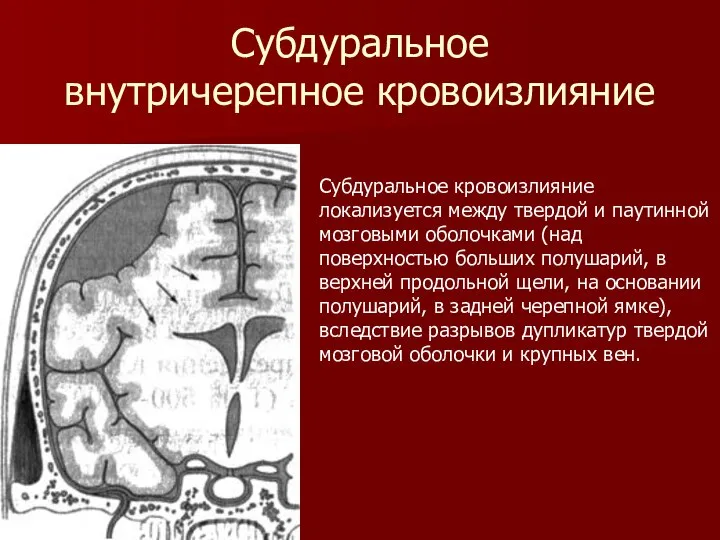 Субдуральное внутричерепное кровоизлияние Субдуральное кровоизлияние локализуется между твердой и паутинной мозговыми