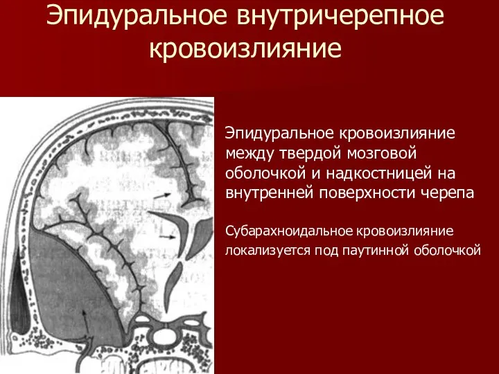 Эпидуральное внутричерепное кровоизлияние Эпидуральное кровоизлияние между твердой мозговой оболочкой и надкостницей