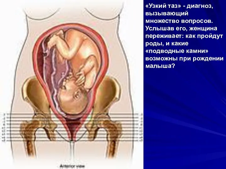 «Узкий таз» - диагноз, вызывающий множество вопросов. Услышав его, женщина переживает: