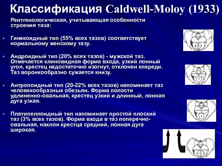 Классификация Caldwell-Moloy (1933) Рентгенологическая, учитывающая особенности строения таза: Гинекоидный тип (55%