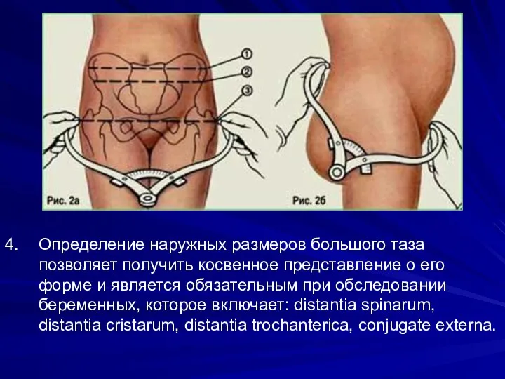 4. Определение наружных размеров большого таза позволяет получить косвенное представление о
