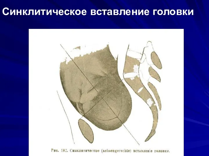 Синклитическое вставление головки