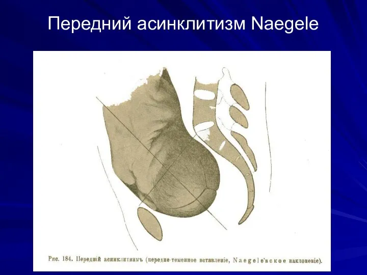 Передний асинклитизм Naegele