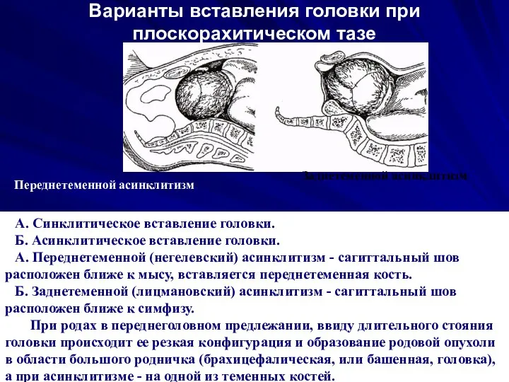 Варианты вставления головки при плоскорахитическом тазе Переднетеменной асинклитизм А. Синклитическое вставление