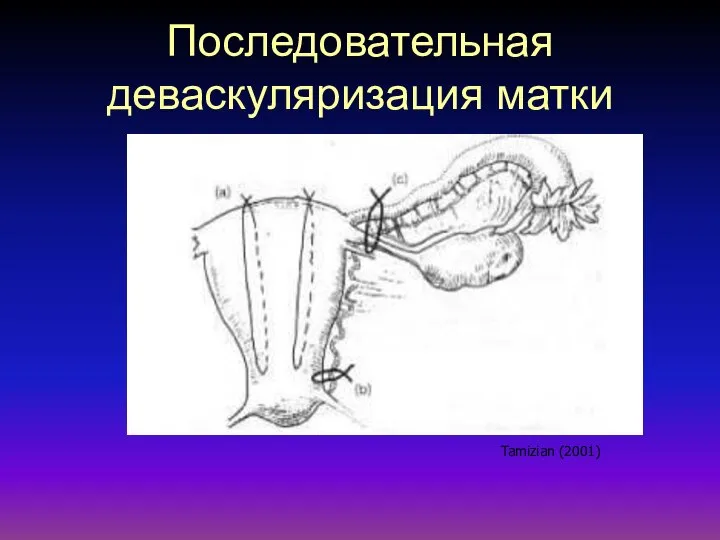 Последовательная деваскуляризация матки Tamizian (2001)