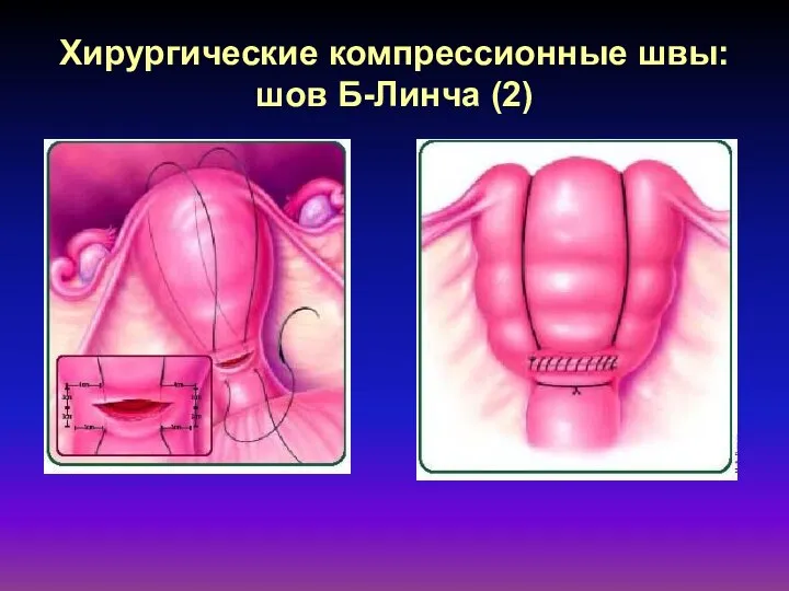 Хирургические компрессионные швы: шов Б-Линча (2)