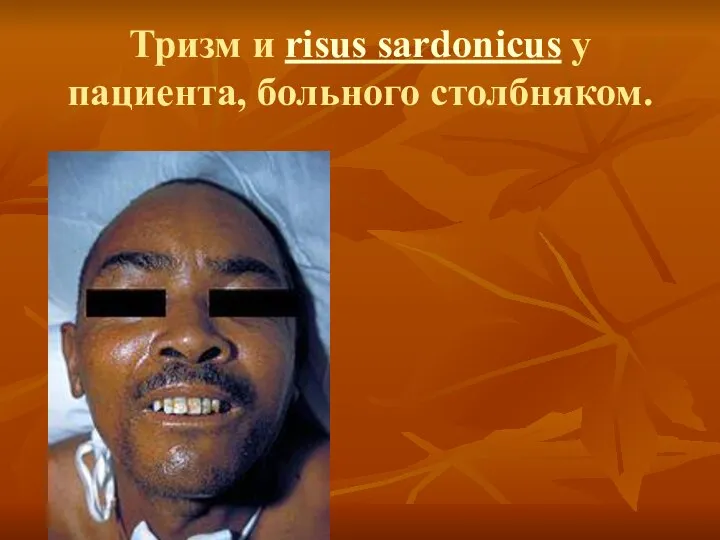 Тризм и risus sardonicus у пациента, больного столбняком.