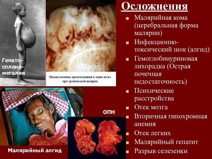 Осложнения Малярийная кома (церебральная форма малярии) Инфекционно-токсический шок (алгид) Гемоглобинуриновая лихорадка