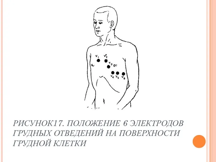 РИСУНОК17. ПОЛОЖЕНИЕ 6 ЭЛЕКТРОДОВ ГРУДНЫХ ОТВЕДЕНИЙ НА ПОВЕРХНОСТИ ГРУДНОЙ КЛЕТКИ