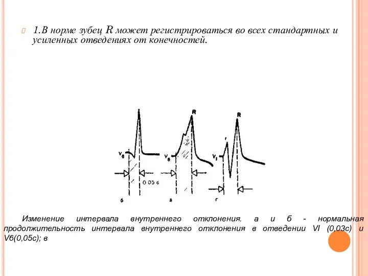 1.В норме зубец R может регистрироваться во всех стандартных и усиленных