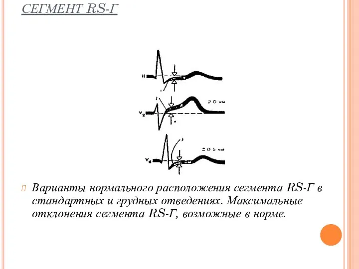 СЕГМЕНТ RS-Г Варианты нормального расположения сегмента RS-Г в стандартных и грудных