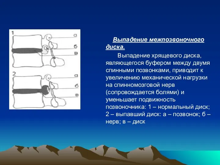 Выпадение межпозвоночного диска. Выпадение хрящевого диска, являющегося буфером между двумя спинными