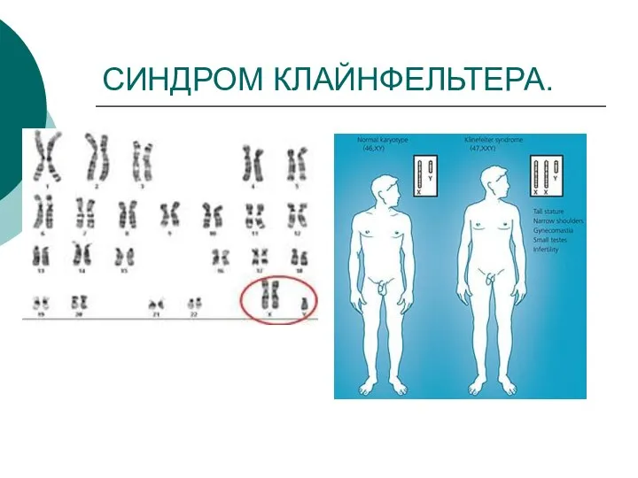 СИНДРОМ КЛАЙНФЕЛЬТЕРА.