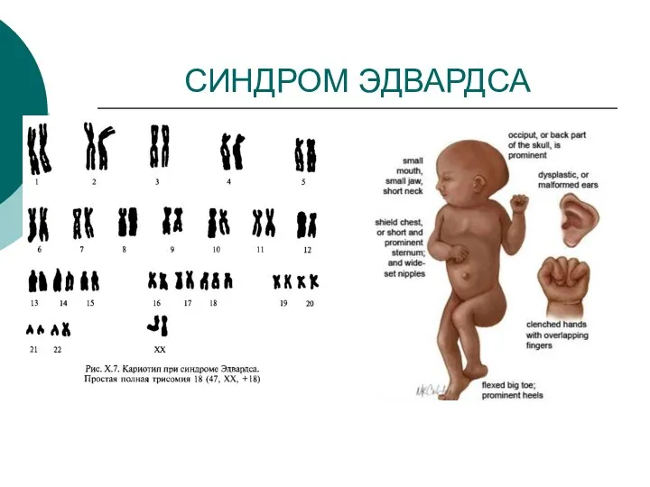 СИНДРОМ ЭДВАРДСА