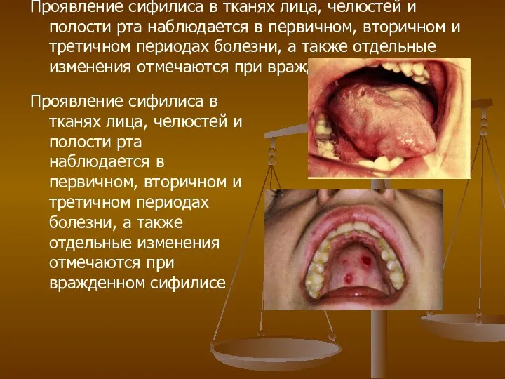 Проявление сифилиса в тканях лица, челюстей и полости рта наблюдается в