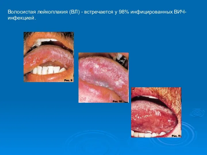 Волосистая лейкоплакия (ВЛ) - встречается у 98% инфицированных ВИЧ-инфекцией.