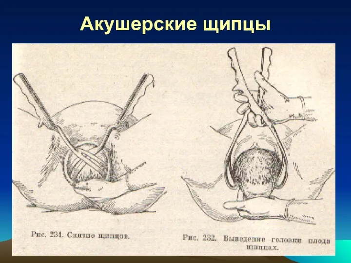 Акушерские щипцы