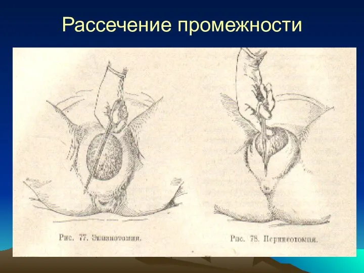 Рассечение промежности