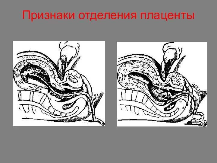 Признаки отделения плаценты