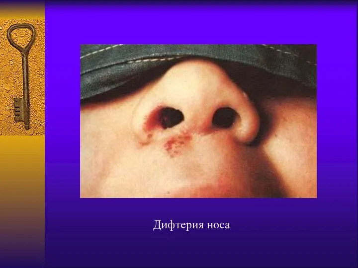 Дифтерия носа