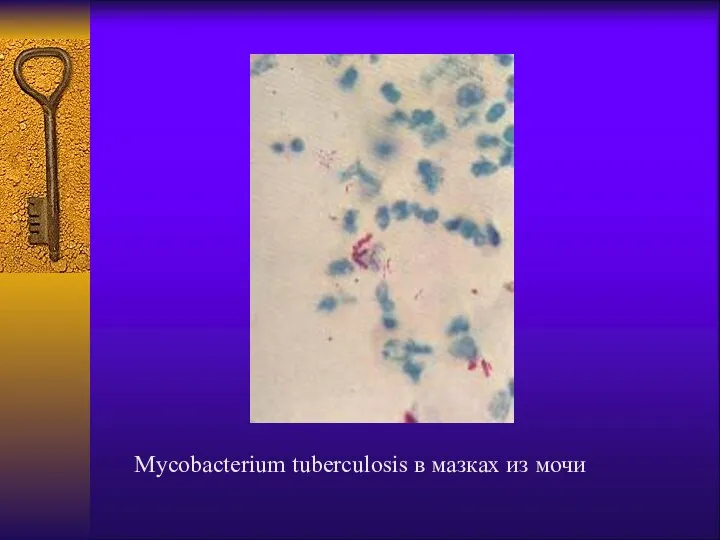 Mycobacterium tuberculosis в мазках из мочи