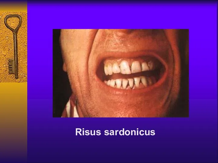 Risus sardonicus