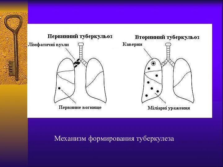 Механизм формирования туберкулеза