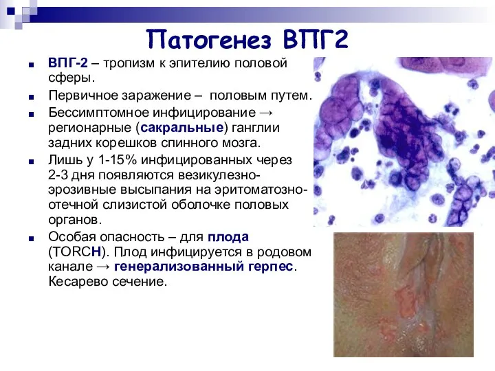 Патогенез ВПГ2 ВПГ-2 – тропизм к эпителию половой сферы. Первичное заражение