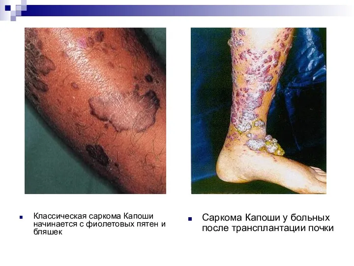 Классическая саркома Капоши начинается с фиолетовых пятен и бляшек Саркома Капоши у больных после трансплантации почки