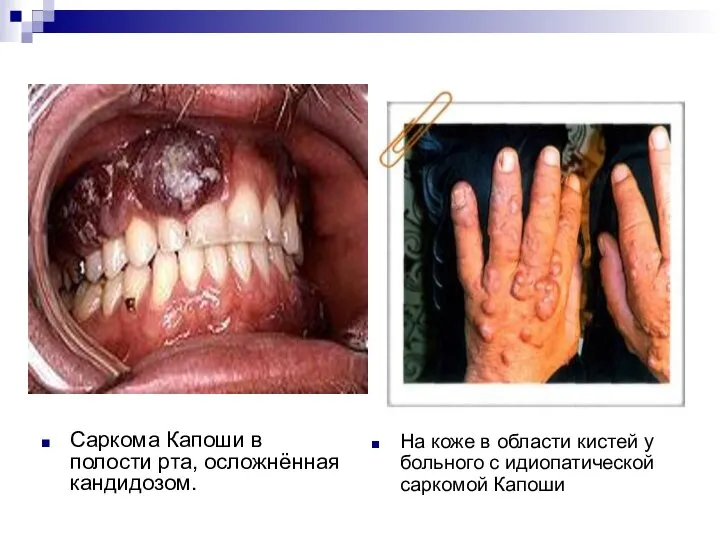 Саркома Капоши в полости рта, осложнённая кандидозом. На коже в области