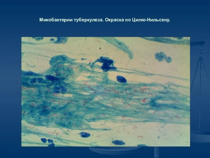 Микобактерии туберкулеза. Окраска по Цилю-Нильсену.
