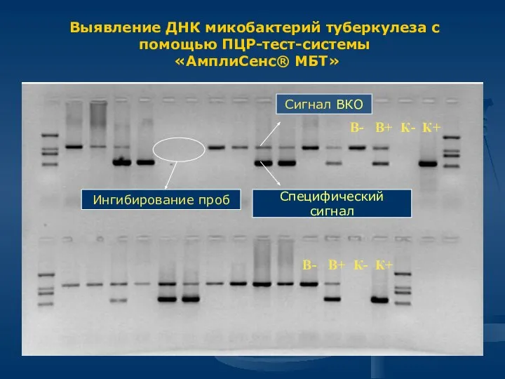 Выявление ДНК микобактерий туберкулеза с помощью ПЦР-тест-системы «АмплиСенс® МБТ» Специфический сигнал Сигнал ВКО Ингибирование проб