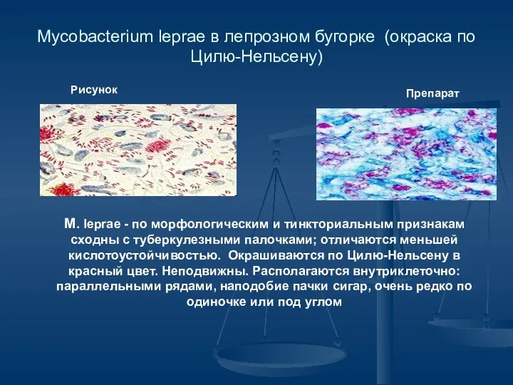 Mycobacterium leprae в лепрозном бугорке (окраска по Цилю-Нельсену) Рисунок Препарат M.