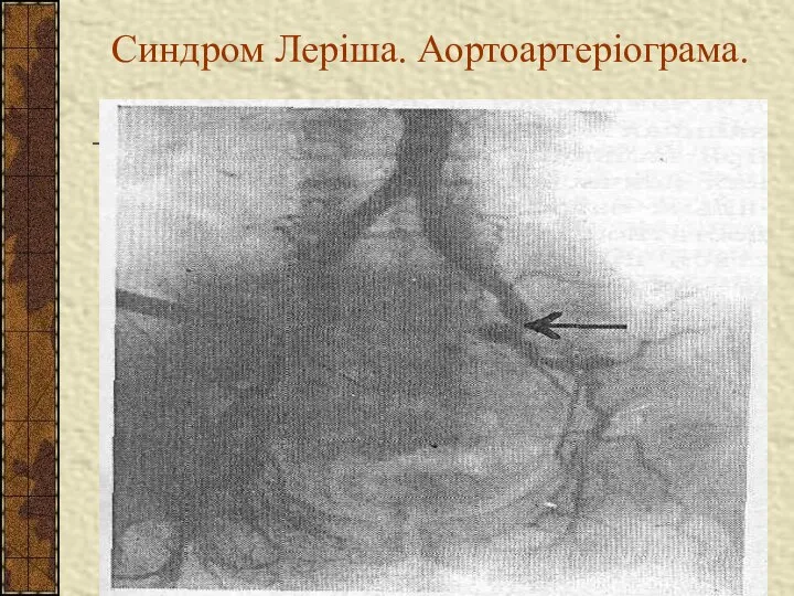 Синдром Леріша. Аортоартеріограма.