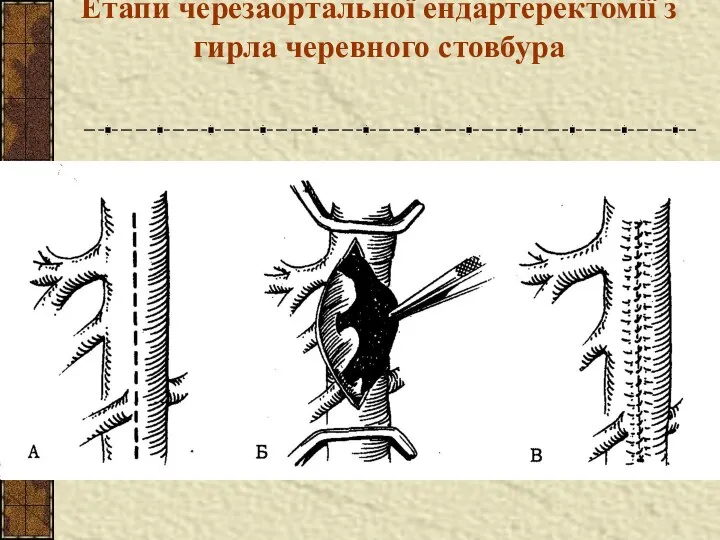 Етапи черезаортальної ендартеректомії з гирла черевного стовбура