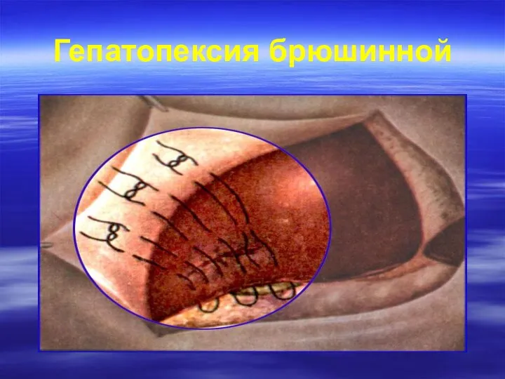 Гепатопексия брюшинной