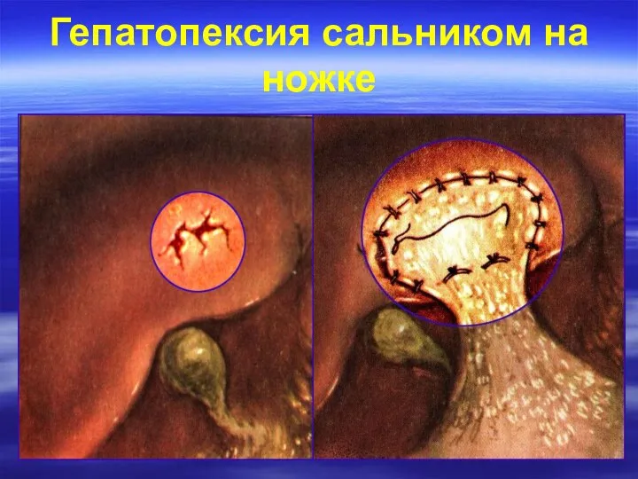 Гепатопексия сальником на ножке