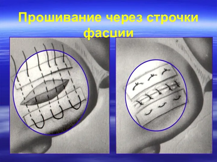 Прошивание через строчки фасции