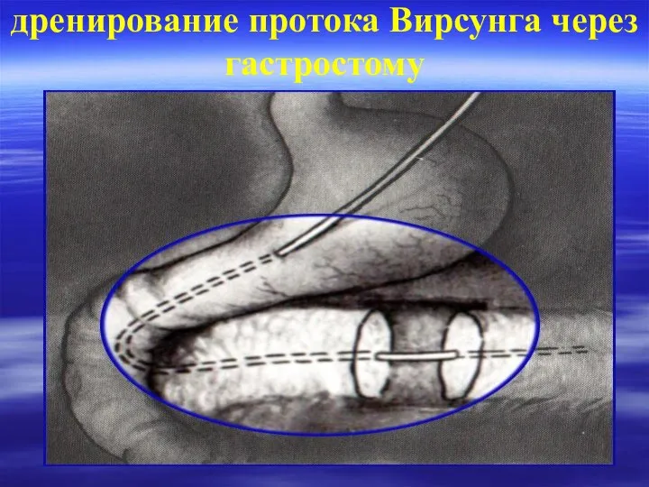 дренирование протока Вирсунга через гастростому