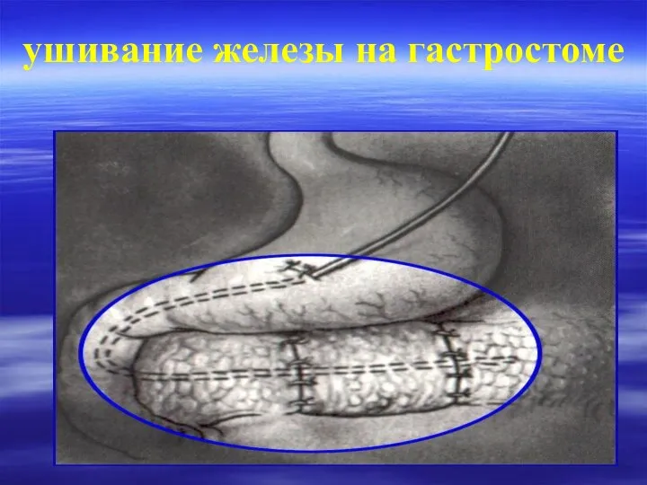 ушивание железы на гастростоме