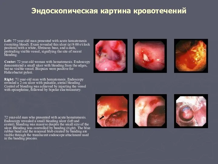 Эндоскопическая картина кровотечений Left: 77 year-old man presented with acute hematemesis