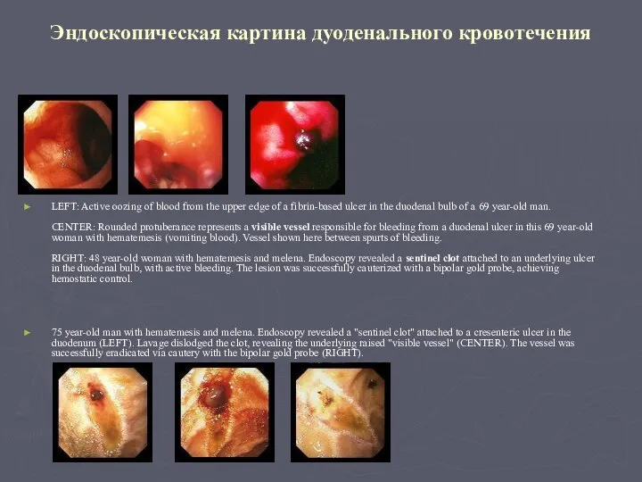 Эндоскопическая картина дуоденального кровотечения LEFT: Active oozing of blood from the