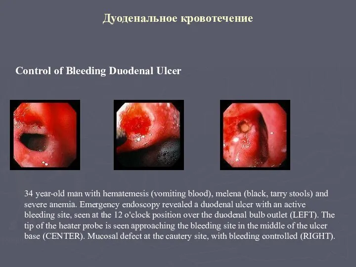 Дуоденальное кровотечение Control of Bleeding Duodenal Ulcer 34 year-old man with