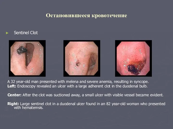 Остановившееся кровотечение Sentinel Clot A 32 year-old man presented with melena