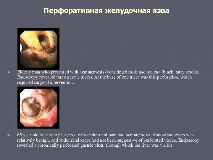 Перфоративная желудочная язва Elderly man who presented with hematemesis (vomiting blood)