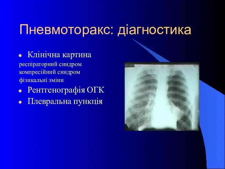 Пневмоторакс: діагностика Клінічна картина респіраторний синдром компресійний синдром фізикальні зміни Рентгенографія ОГК Плевральна пункція