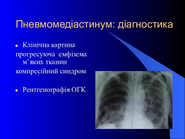 Пневмомедіастинум: діагностика Клінічна картина прогресуюча емфізема м’яких тканин компресійний синдром Рентгенографія ОГК