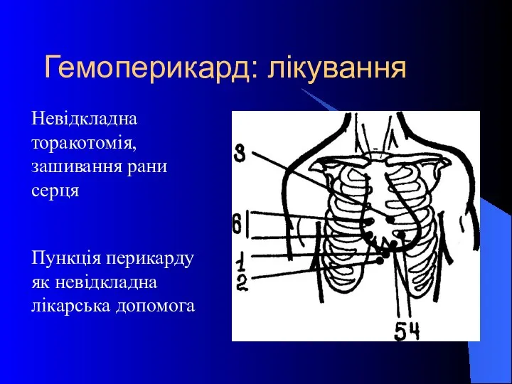 Гемоперикард: лікування Невідкладна торакотомія, зашивання рани серця Пункція перикарду як невідкладна лікарська допомога